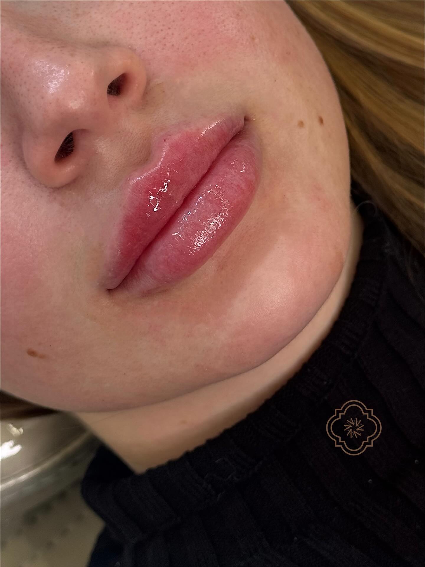 Procedimento Volume Labial na Experiência Millano