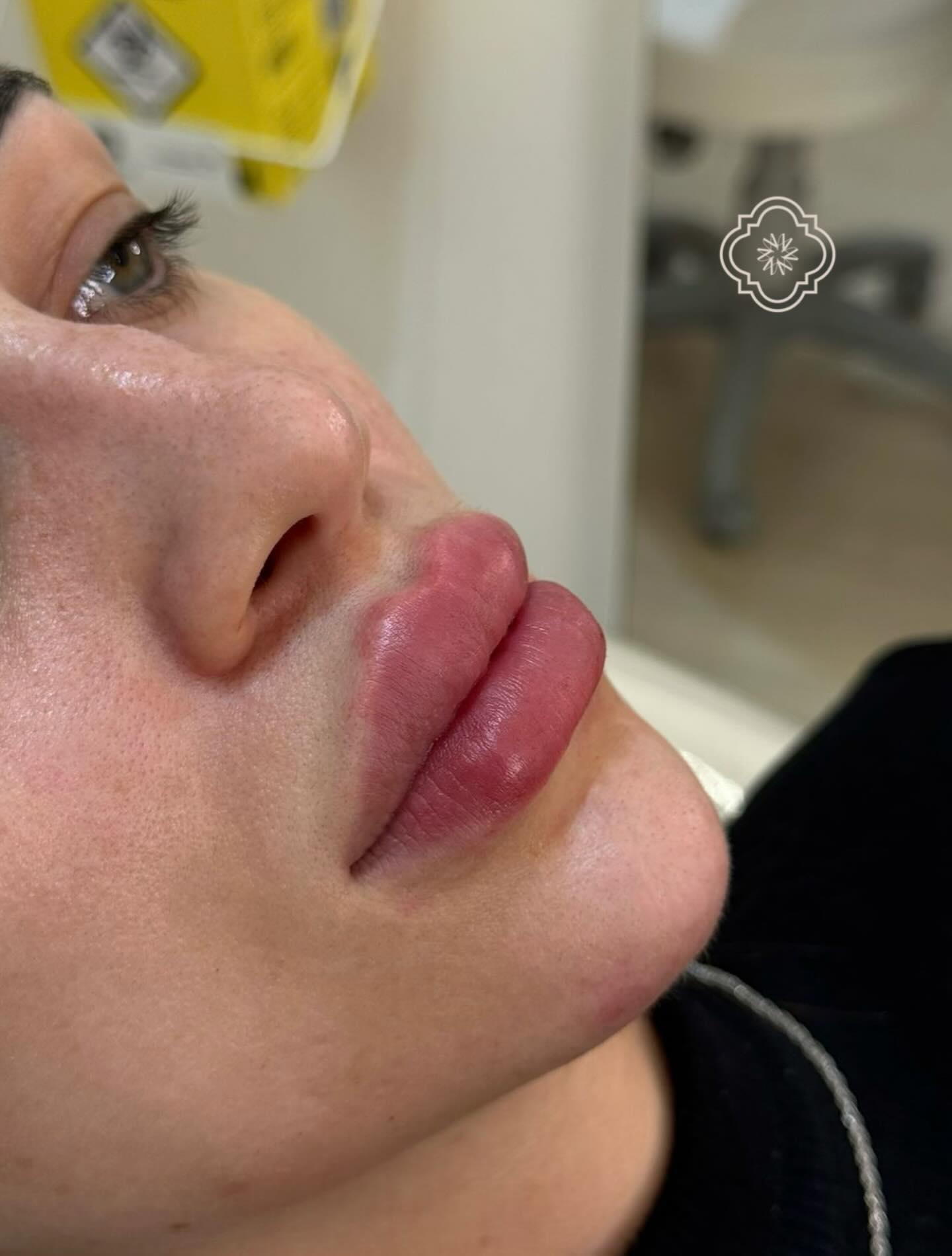 Procedimento Harmonização Labial na Experiência Millano