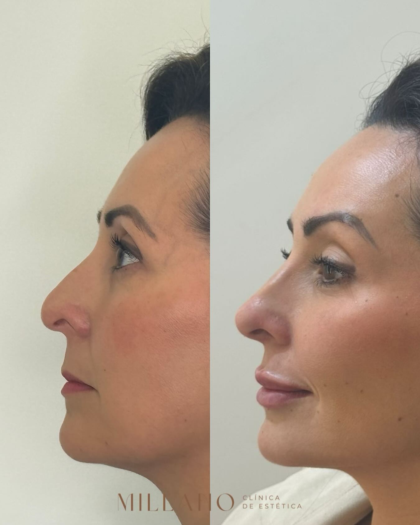 Procedimento Harmonização Facial na Experiência Millano