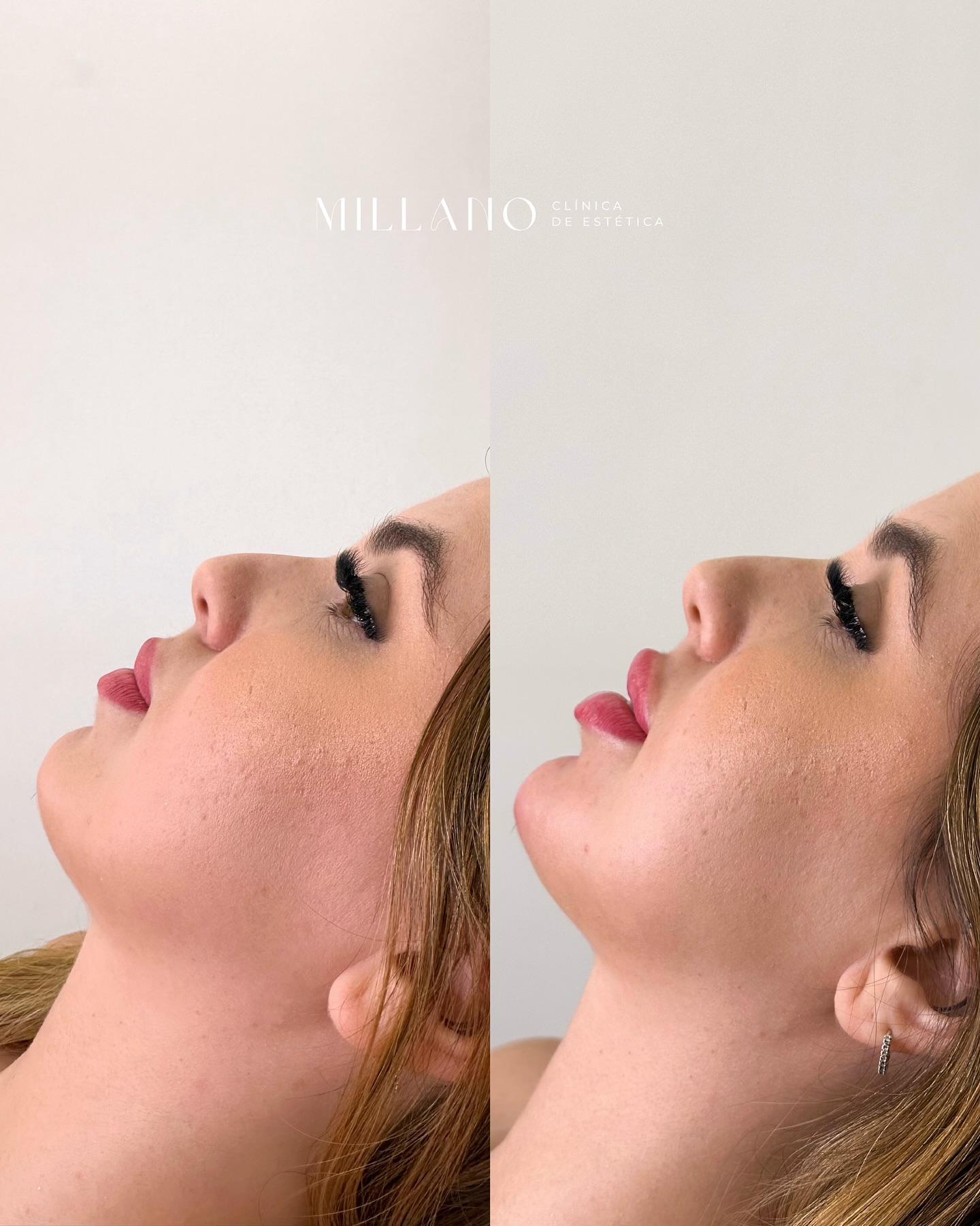 Procedimento Experiência Millano na Experiência Millano