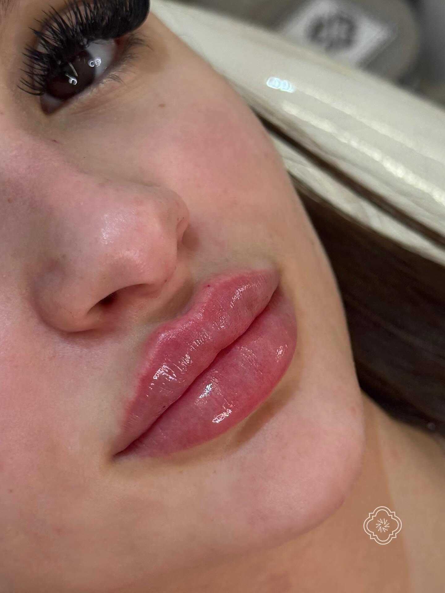 Procedimento Preenchimento Labial na Experiência Millano